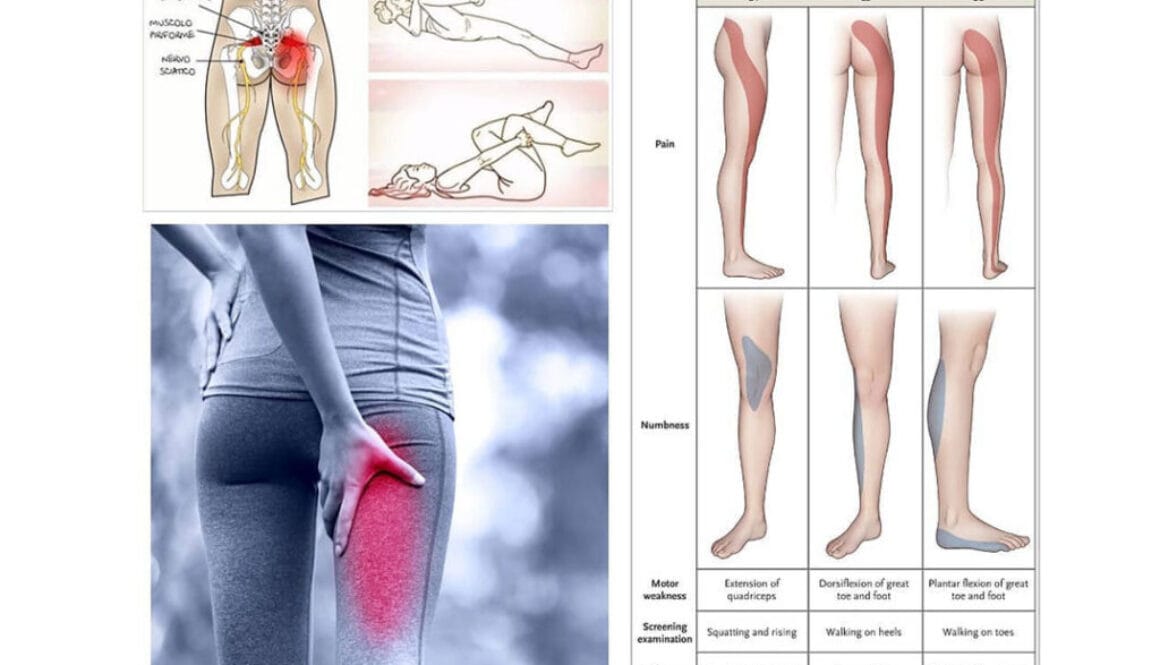 Articolo-sciatalgia