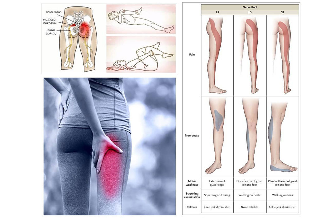 Articolo-sciatalgia